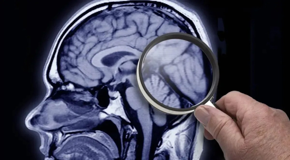 Cientistas descobrem proteína que acelera o desenvolvimento do Alzheimer
