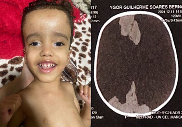 Menino com menos de 30% do cérebro desafia a medicina na Paraíba