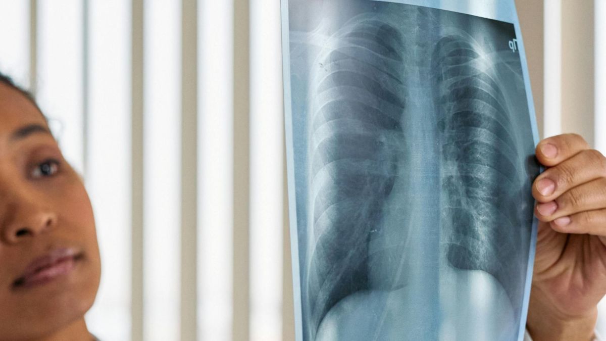 Câncer de pulmão: 7 mitos comuns que atrapalham o diagnóstico